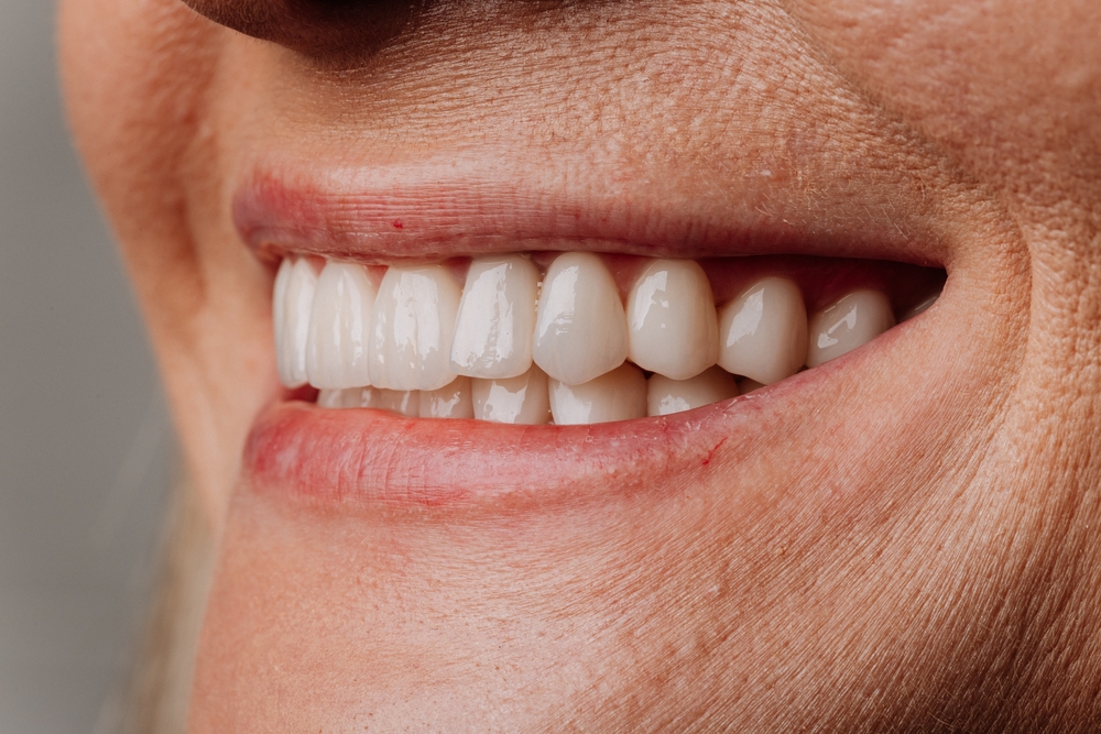 Dental Implant Restorations Frederick